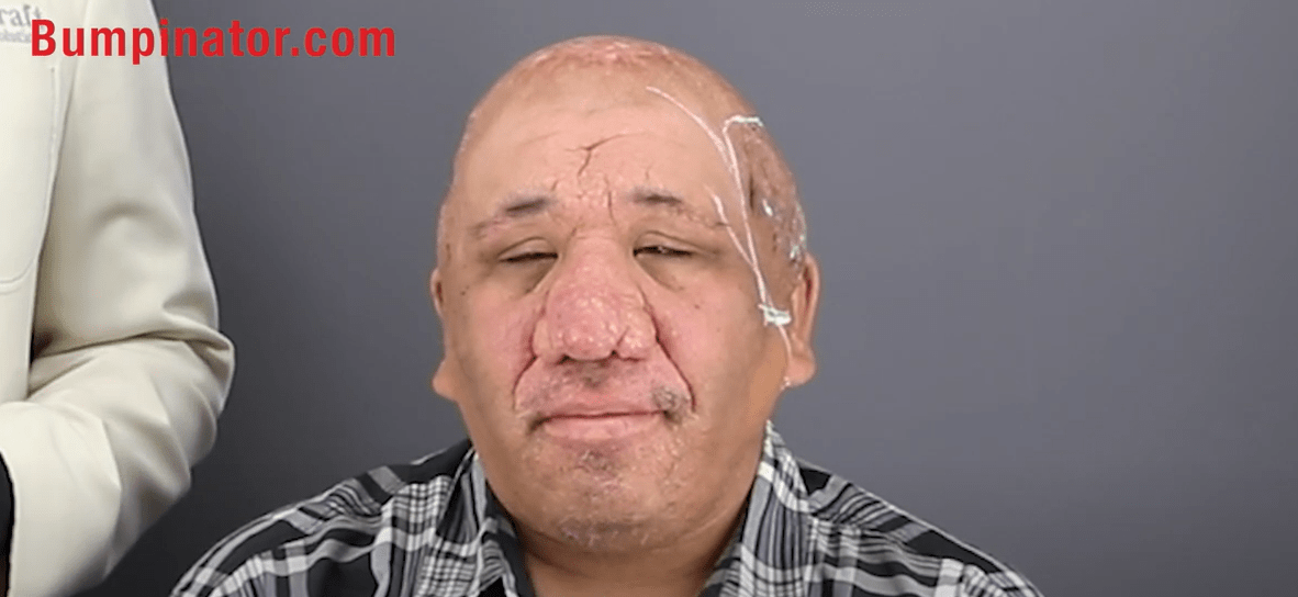 Robert Peeters - Happier now that some of his AKN and skin conditions are gone thanks to radiation therapy done by Dr. Sanusi Umar, AKA The Bumpinator.