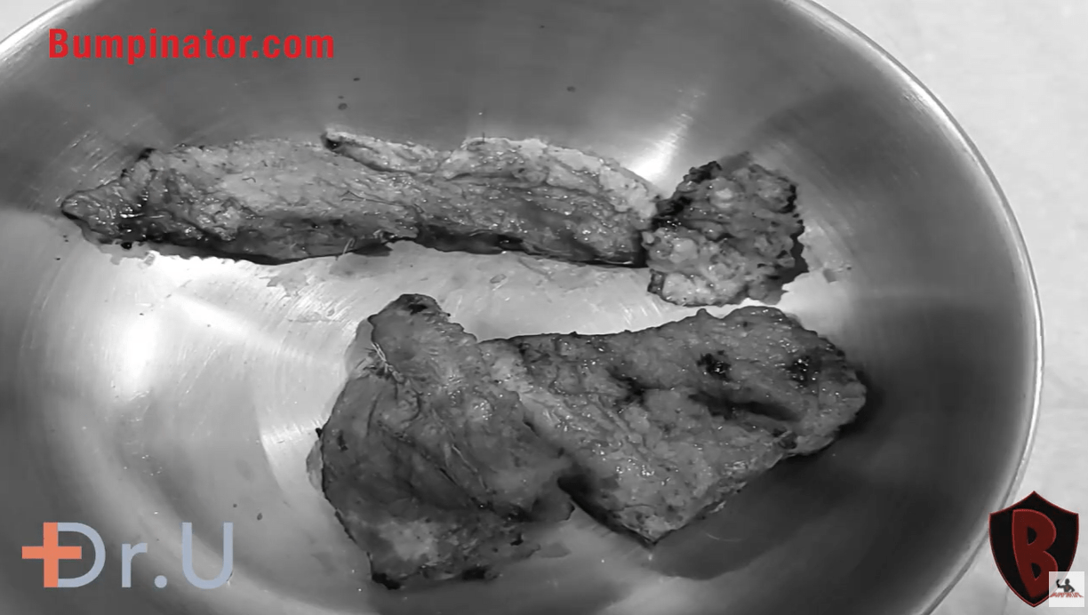Large side lesion removed by Dr. U.