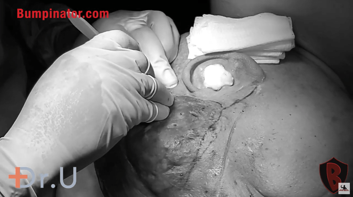 Dr. Sanusi Umar AKA The Bumpinator using surgical tools to safely remove the large side AKN lesion on the patient's scalp.