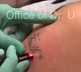 Los Angeles Laser tattoo removal session - before the procedure.*