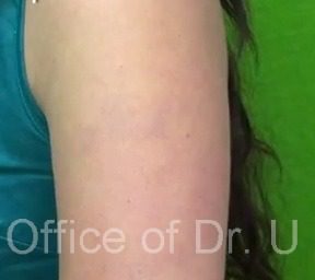 Successful Los Angeles Black Arm Tattoo Removal | Black Arm Tattoo Lettering*