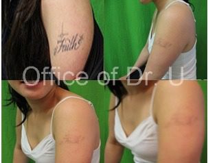 Dr. U Skin & Hair Clinic Los Angeles Laser Black Arm Tattoo Removal sessions progress.*