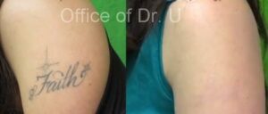 Laser tattoo removal final before and after results - Dr. U Skin & Hair Clinic*