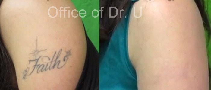 Laser tattoo removal final before and after results.*