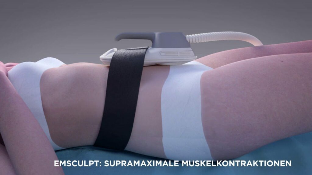 Emsculpt uses high-intensity focused electromagnetic (HIFEM) technology to tone the muscles.