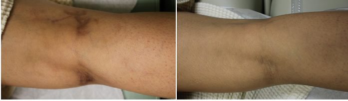 Before and after pictures of leg vein removal procedure with Gentle YAG - Dr. U Skin & Hair Clinic