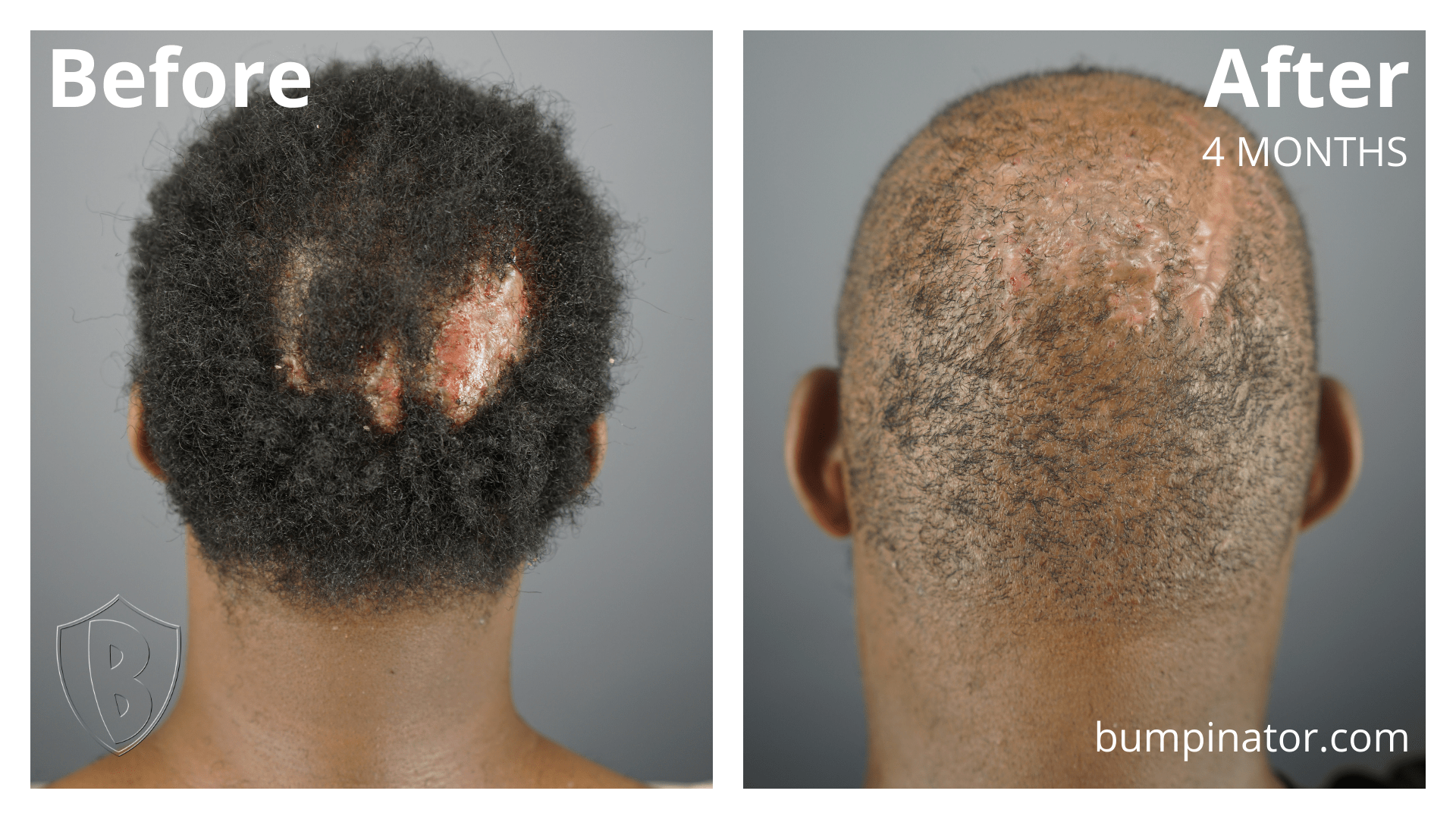 Bumpinator - Folliculitis Decalvans FD Removal Surgery Before and After Results, 4 months post treatment.