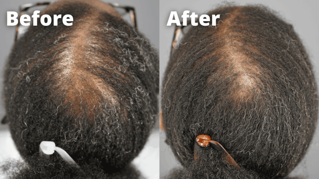 A before and after using Gashee botanical products in a CCCA patient as published in the peer-reviewed dermatology journal, Clinical Cosmetic and Investigational Dermatology.*