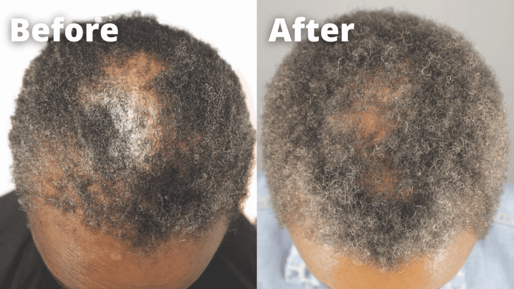 Another patient's before and after picture results were featured in a published peer-review journal, demonstrating the positive response of GASHEE on CCCA patients.*