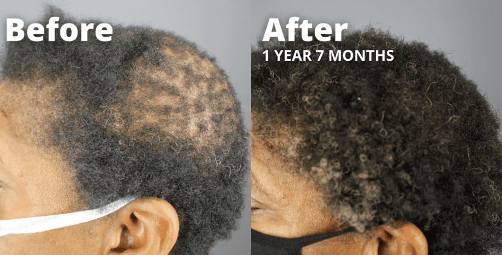 Patient before and after picture results were featured in a published peer-reviewed journal demonstrating the positive response of GASHEE on CCCA patients.*