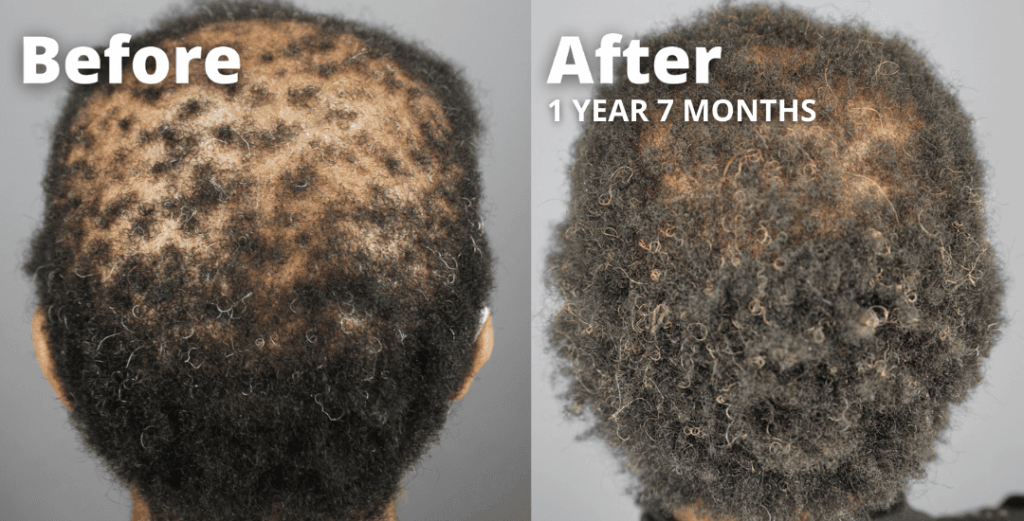 Patient before and after picture results were featured in a published peer-reviewed journal demonstrating the positive response of GASHEE on CCCA patients - rear view*