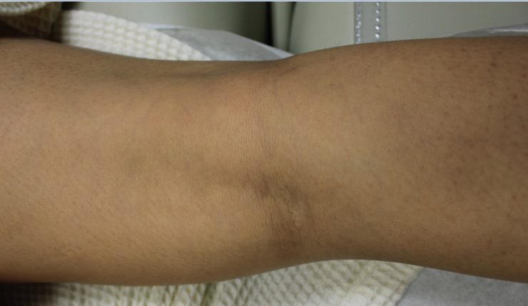 Close up view of leg after the Gentle YAG treatment procedure*