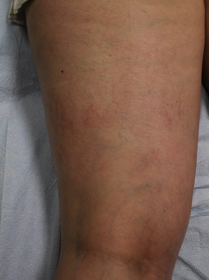 Final results of using Asclera - Dr. U Skin & Hair Clinic Los Angeles, California