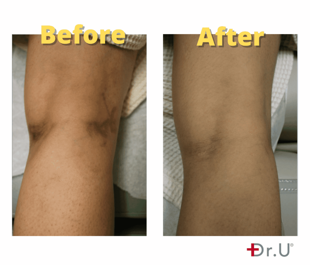 Leg Vein Laser Removal - Dr. U Skin & Hair Clinic, Manhattan Beach, CA