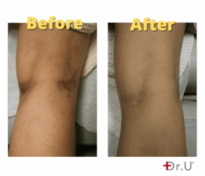 Leg Vein Laser Removal - Dr. U Skin & Hair Clinic, Manhattan Beach, CA