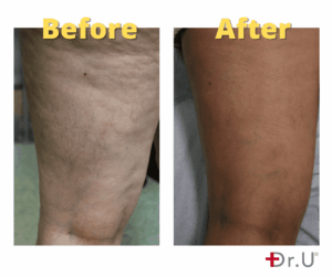 Leg Vein Removal Before & After Results V1 - Dr. U Skin & Hair Clinic Los Angeles CA