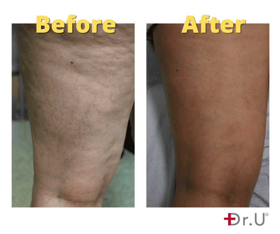Leg Vein Removal Before & After Results V1 - Dr. U Skin & Hair Clinic Los Angeles CA*