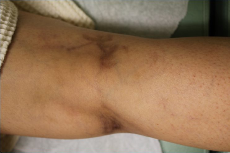 Leg veins prior to removal procedure*