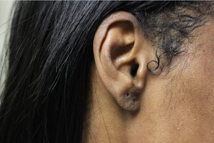 Los Angeles patient's ear after her earlobe reconstruction procedure*