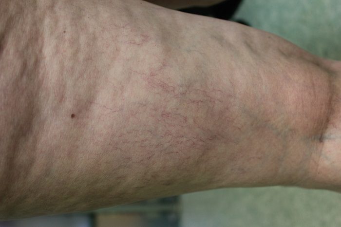 Patient before leg vein treatment with Asclera - Dr. U Skin & Hair Clinic Manhattan Beach, CA