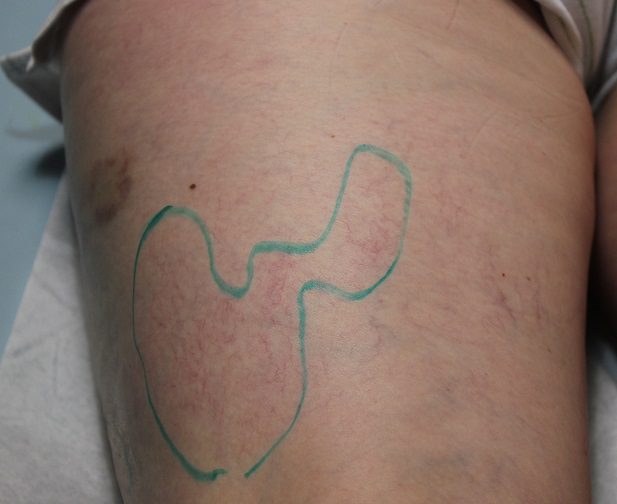 Targeted area of Asclera injections - Dr. U Skin & Hair Clinic, Manhattan Beach, CA