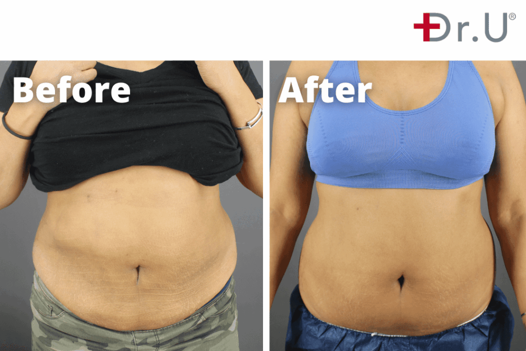 BodyTite Patient Before & After Results 1