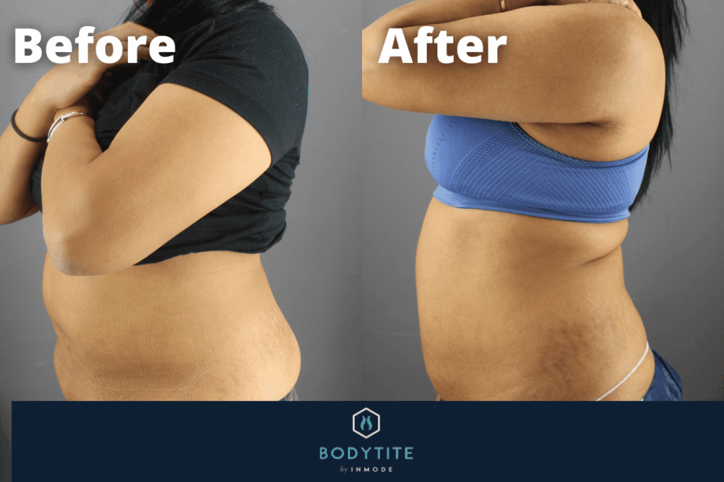 BodyTite Patient Before & After Results 2