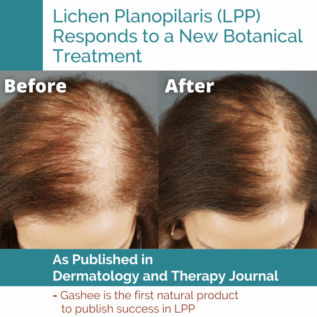 LPP Before and After Results - Patient in Peer-Reviewed Study Used Gashee Natural Hair Products for LPP - Dr. U Skin & Hair Clinic, Dr. Sanusi Umar, MD*