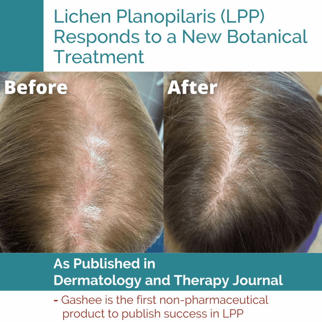 LPP Before and After Results - Patient in Peer-Reviewed Study Used Gashee Natural Hair Products for LPP #2*