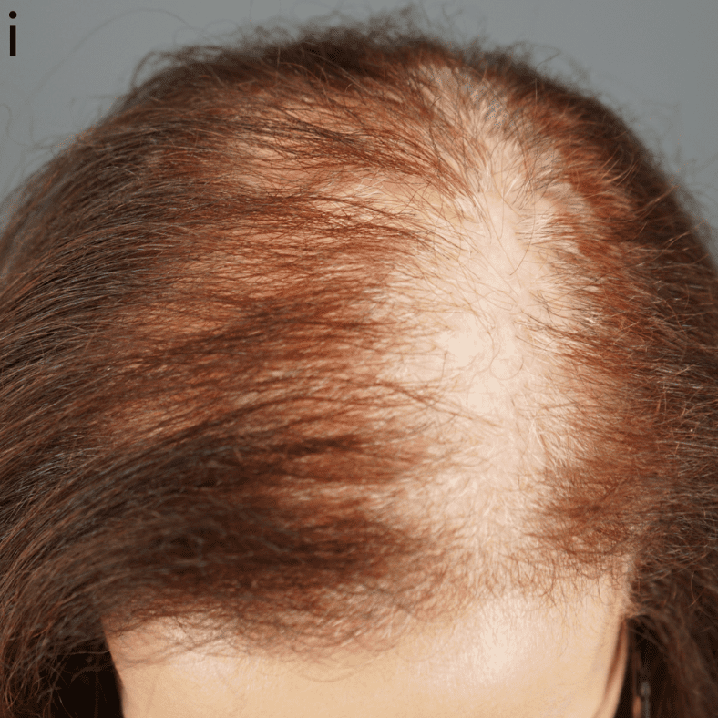 Example of LPP patient showing symptoms of LPP such as scalp redness and scarring hair loss.*