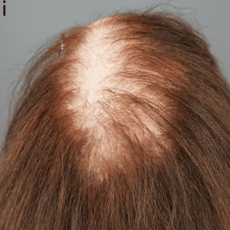 Different angle view of LPP (Lichen Planopilaris). Note the scarring hair loss pervading throughout the patient's scalp.*