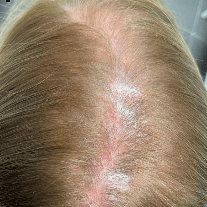 Patient Example of LPP (Lichen Planopilaris) - Notice the redness and scarring - this can be seen in some cases of LPP patients. It is best to diagnose the condition with an experienced dermatologist and hair expert if you suspect that you have LPP.*