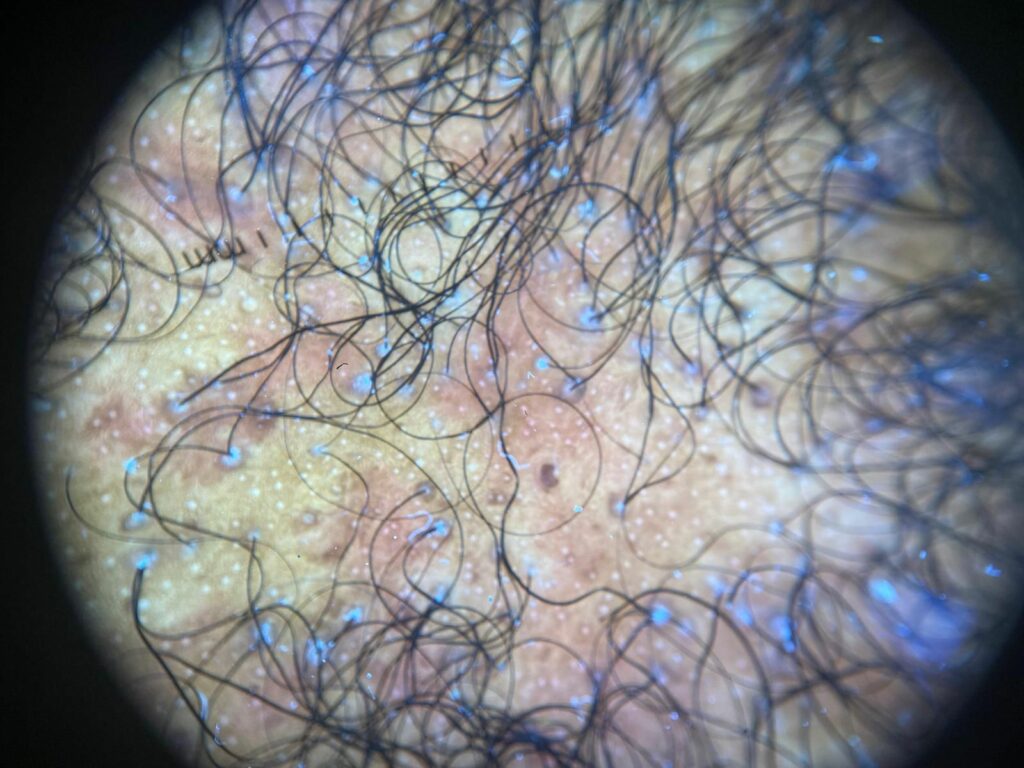 LPP Lichen Planopilaris Trichoscopy Patient Example - Dr. U Skin & Hair Clinic*
