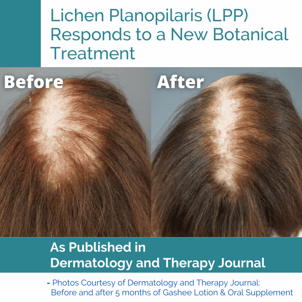 Lichen Planopilaris LPP Responds to a New Botanical Treatment - Before and After Results using natural botanicals.*