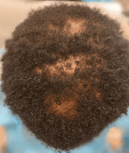 Lichen Planopilaris (LPP) is the most common type of scarring alopecia, accounting for up to 10% of the cases.