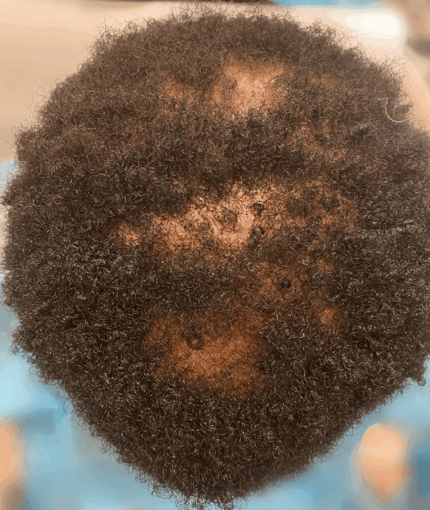 Lichen Planopilaris (LPP) is the most common type of scarring alopecia, accounting for up to 10% of the cases.