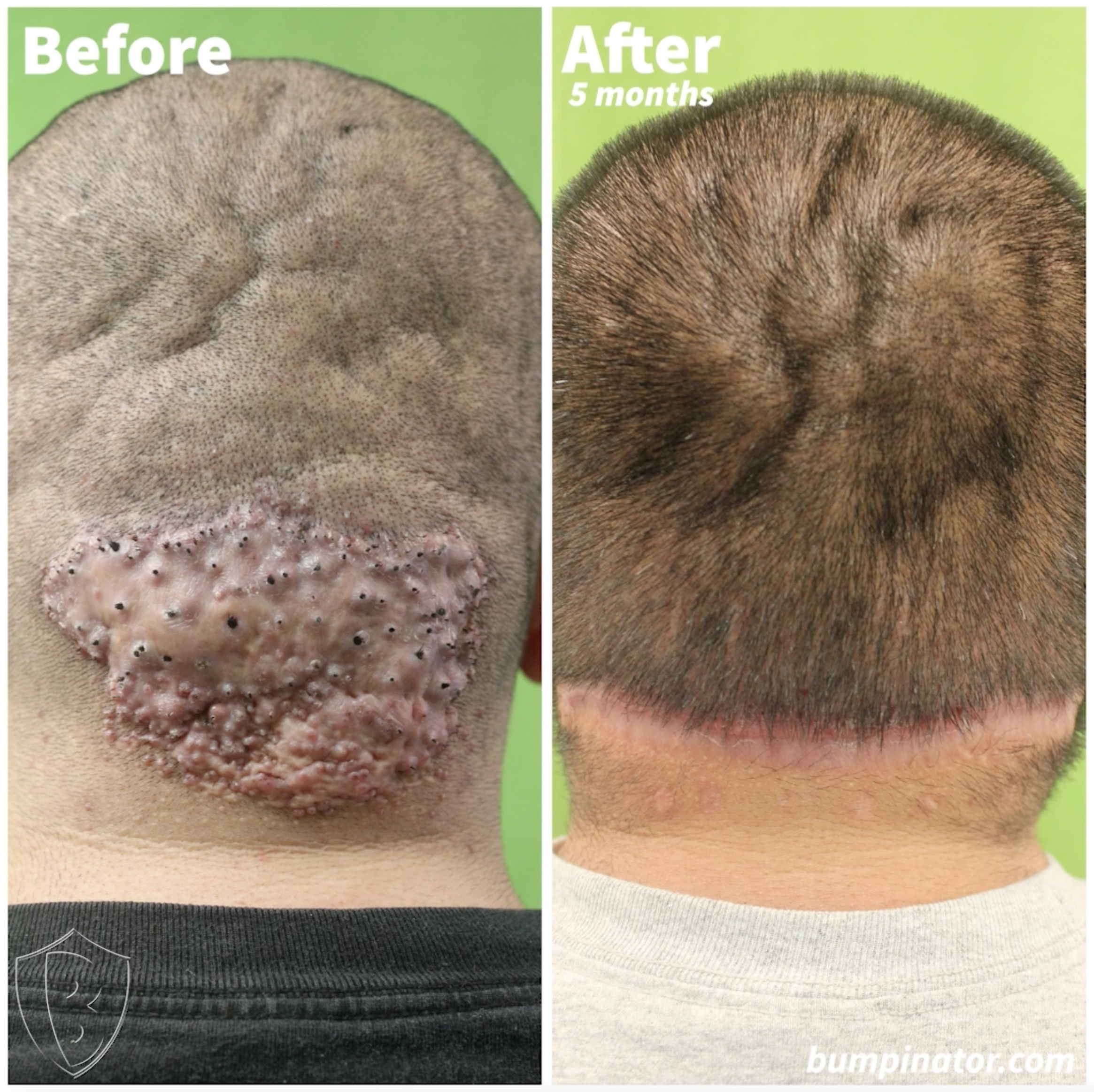 AKN Plaque Removal Before and After Patient Results - Dr. U Skin & Hair Clinic