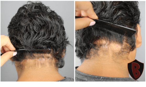 Figure 4 Only 9  months post-surgery, the patient’s scar is already looking much better. *