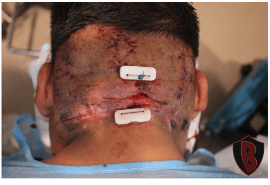 Figure 2 Dr. Umar, AKA the Bumpinator, used the Athena sutures he invented to remove the AKN plaques successfully.*