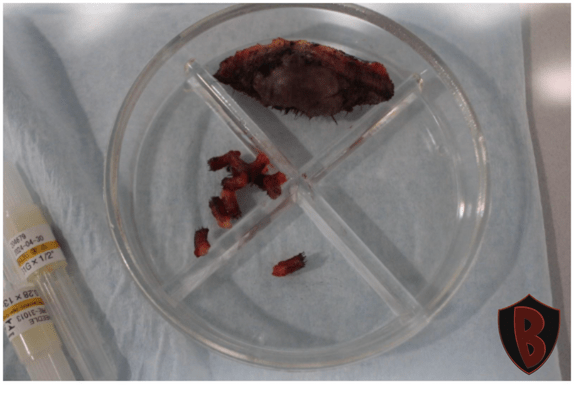 Figure 3 Dr. Umar surgically removed the AKN plaques and the bumps from the patient’s head.*