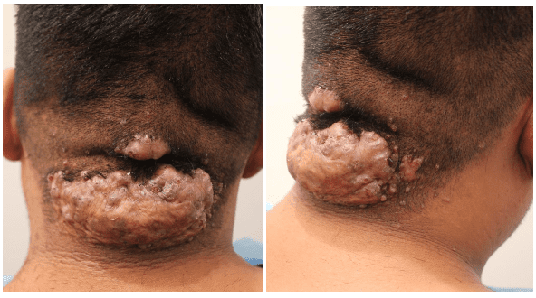 The AKN patient had two lesions and many small bumps, which he wanted to be removed by Dr. Umar. * The AKN patient had two lesions and many small bumps, which he wanted to be removed by Dr. Umar. *