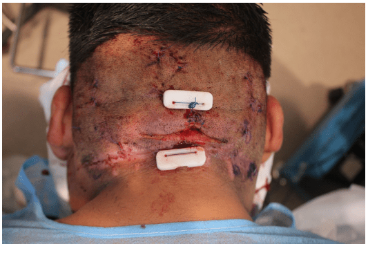 Dr. Umar, AKA the Bumpinator, used the Athena sutures he invented to remove the AKN plaques successfully.* Dr. Umar, AKA the Bumpinator, used the Athena sutures he invented to remove the AKN plaques successfully.*