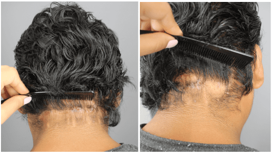 Only 9 months post-surgery, the patient’s scar is already looking much better. * Only 9 months post-surgery, the patient’s scar is already looking much better. *