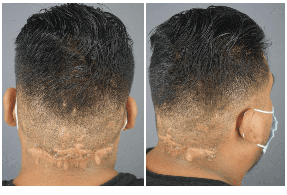 1 year and 8 months after his removal surgery, and the scar is healing so well, the patient feels comfortable enough to have a short haircut. * 1 year and 8 months after his removal surgery, and the scar is healing so well, the patient feels comfortable enough to have a short haircut. *