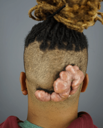 Robert’s big keloid bump started developing when he was only 9 years old. *