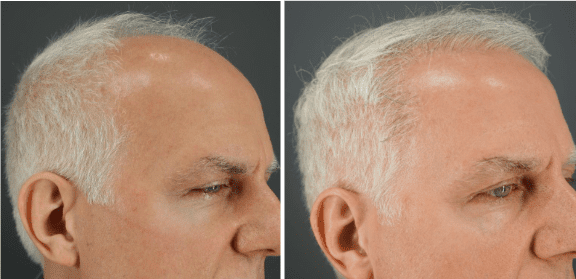 Through the UGraft Zeus FUE operation, the male patient was able to get an improved hairline. *
