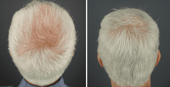 treatment for male pattern baldness*