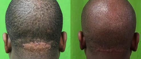 With a small lump on the back of the head, the surgical cure to AKN with Dr. U was highly successful, resulting in a discrete linear scar at the base of the neck.*