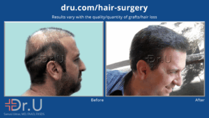 Dr.U's hairline for this repair patient gives him the normal and natural looking appearance he wanted for so long, after his botched hair transplant *