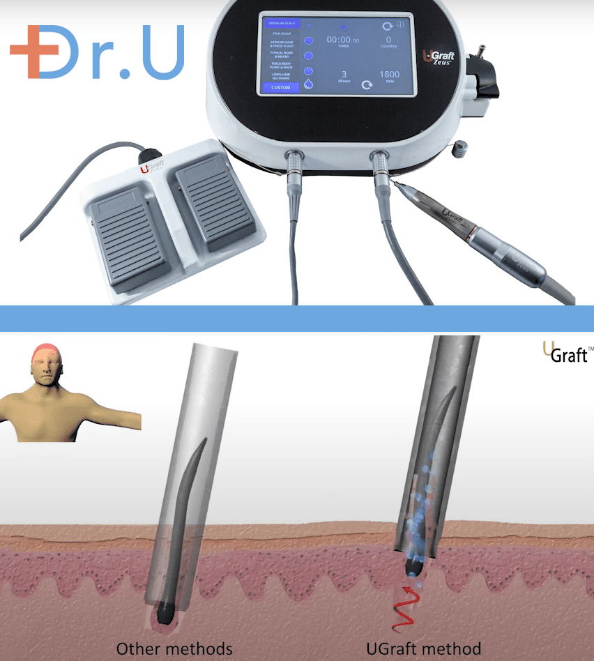 The Advanced Dr.UGraft FUE method created and used by Dr. Sanusi Umar.